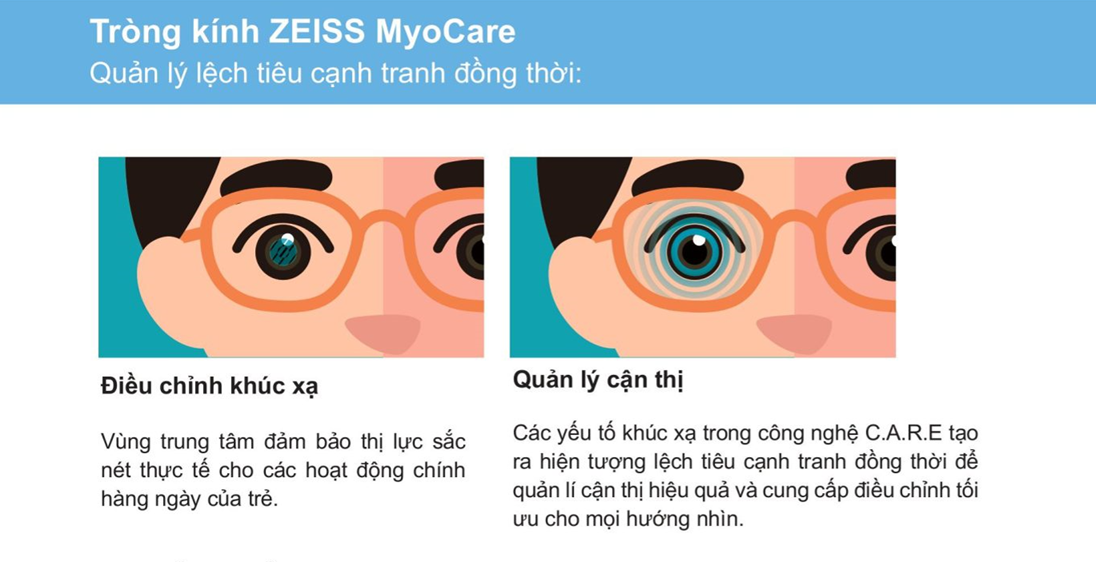 Tròng Kính ZEISS MyoCare Có Thực Sự Hiệu Quả Trong Việc Kiểm Soát Cận Thị Trẻ Em?